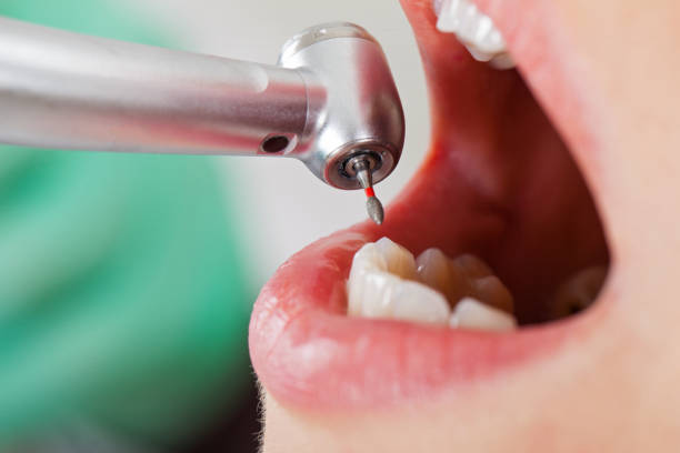 Best Emergency Tooth Extraction in Nome, AK